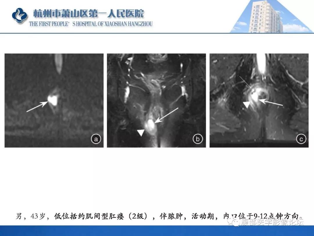 影像PPT - 【PPT】肛瘘MRI诊断-24 影像PPT - 【PPT】肛瘘MRI诊断-24