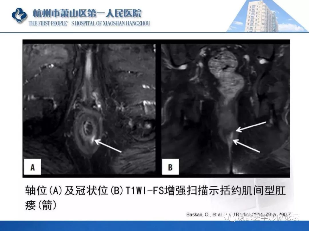 影像PPT - 【PPT】肛瘘MRI诊断-25 影像PPT - 【PPT】肛瘘MRI诊断-25