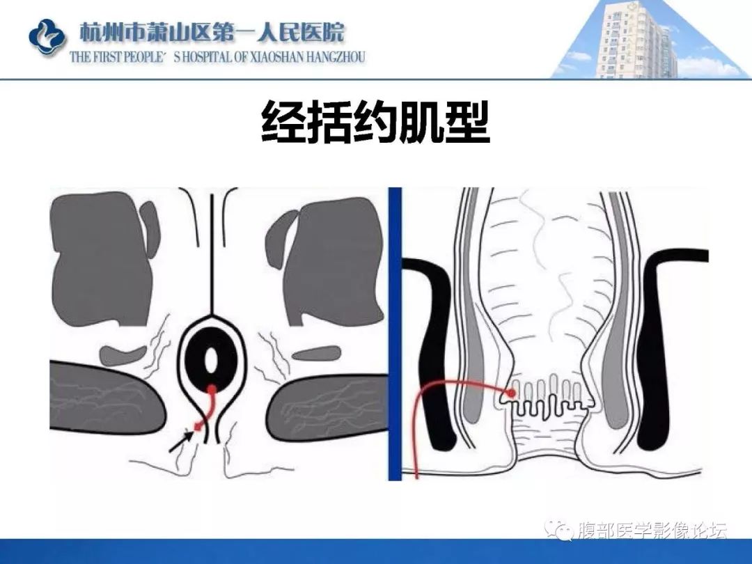 影像PPT - 【PPT】肛瘘MRI诊断-26 影像PPT - 【PPT】肛瘘MRI诊断-26