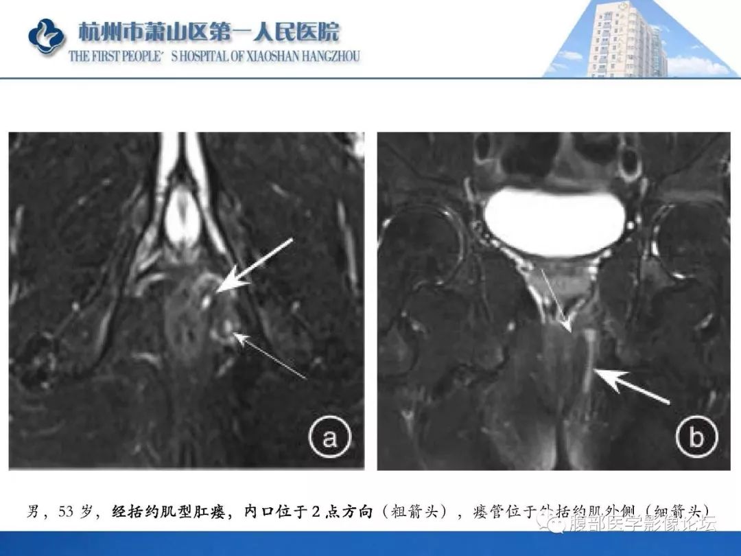 影像PPT - 【PPT】肛瘘MRI诊断-27 影像PPT - 【PPT】肛瘘MRI诊断-27