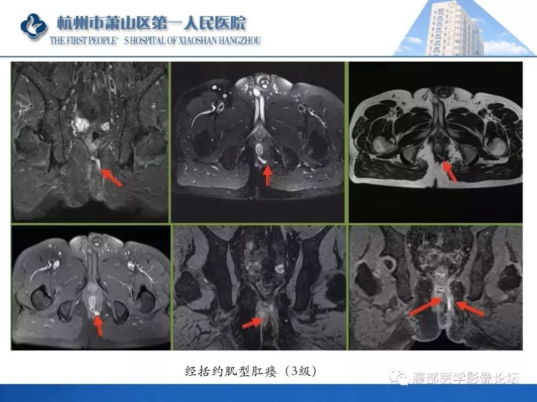 影像PPT - 【PPT】肛瘘MRI诊断-28 影像PPT - 【PPT】肛瘘MRI诊断-28