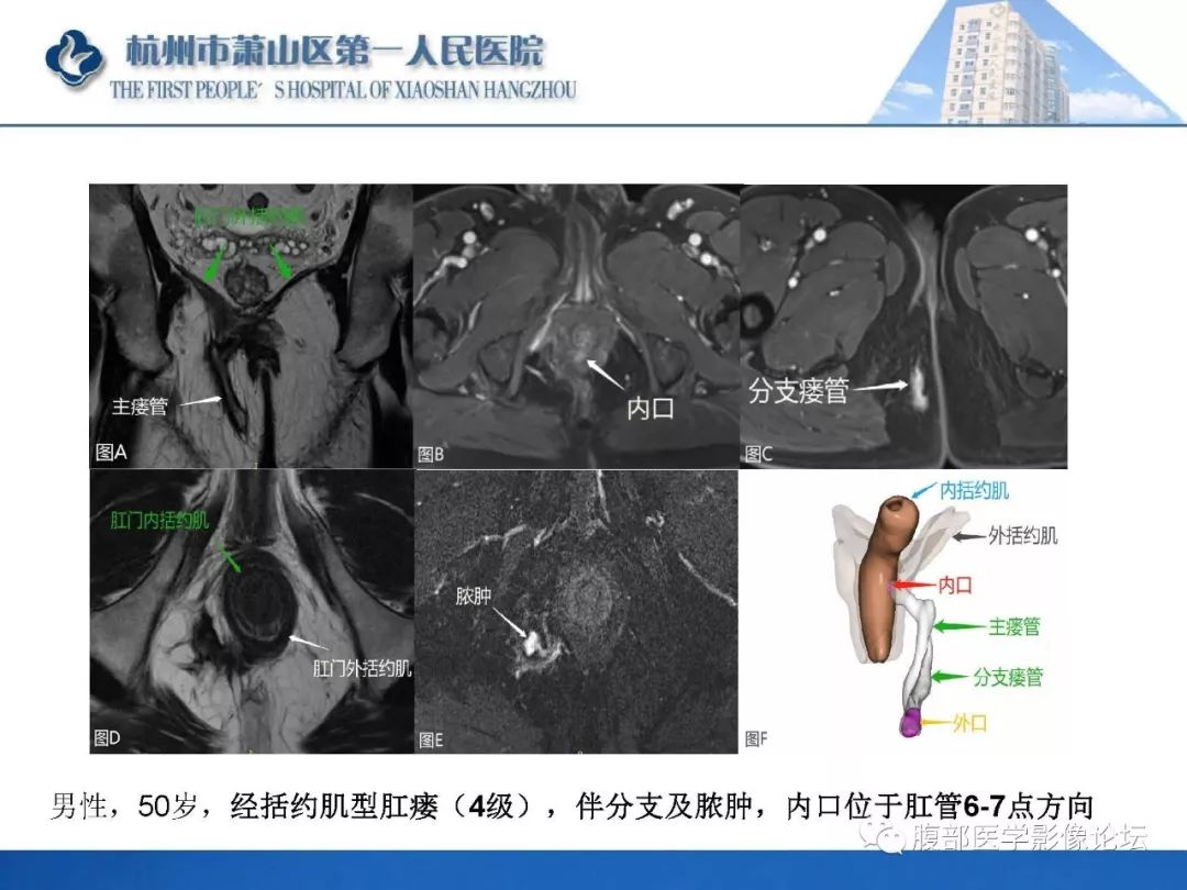 影像PPT - 【PPT】肛瘘MRI诊断-29 影像PPT - 【PPT】肛瘘MRI诊断-29