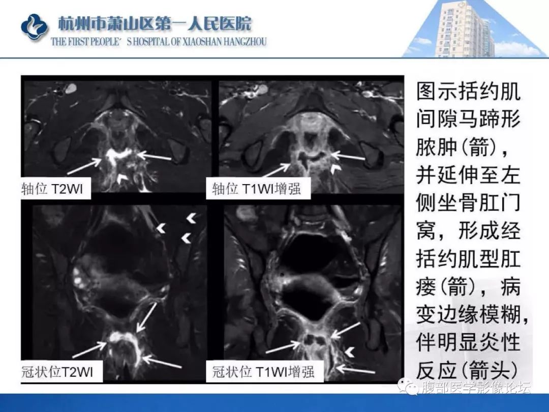影像PPT - 【PPT】肛瘘MRI诊断-30 影像PPT - 【PPT】肛瘘MRI诊断-30