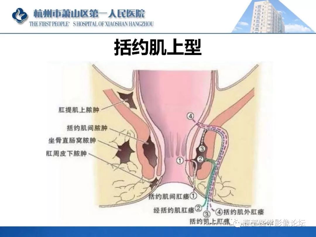影像PPT - 【PPT】肛瘘MRI诊断-31 影像PPT - 【PPT】肛瘘MRI诊断-31