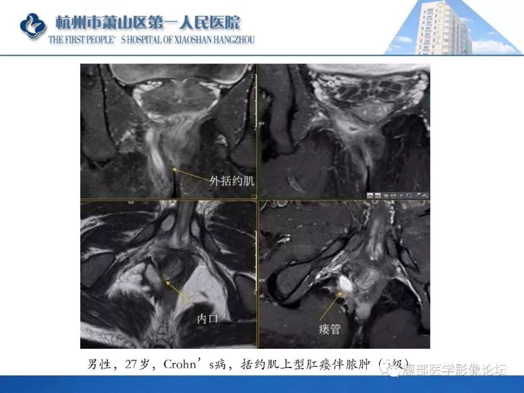 影像PPT - 【PPT】肛瘘MRI诊断-32 影像PPT - 【PPT】肛瘘MRI诊断-32
