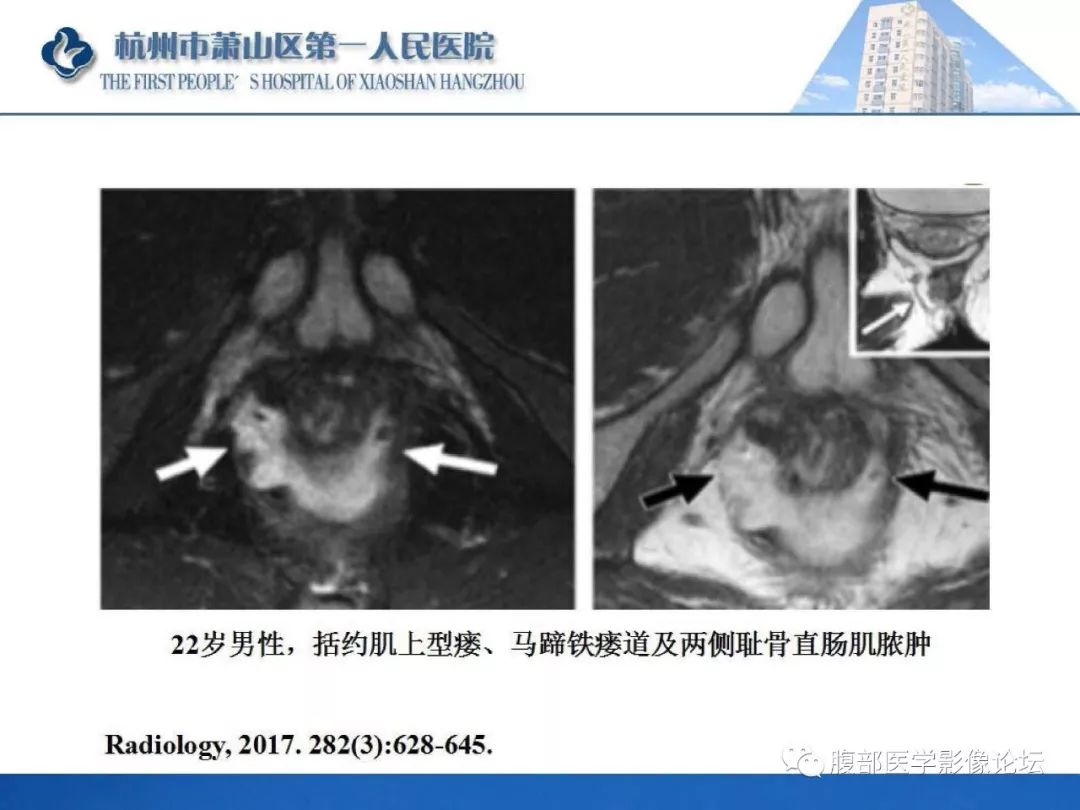 影像PPT - 【PPT】肛瘘MRI诊断-33 影像PPT - 【PPT】肛瘘MRI诊断-33