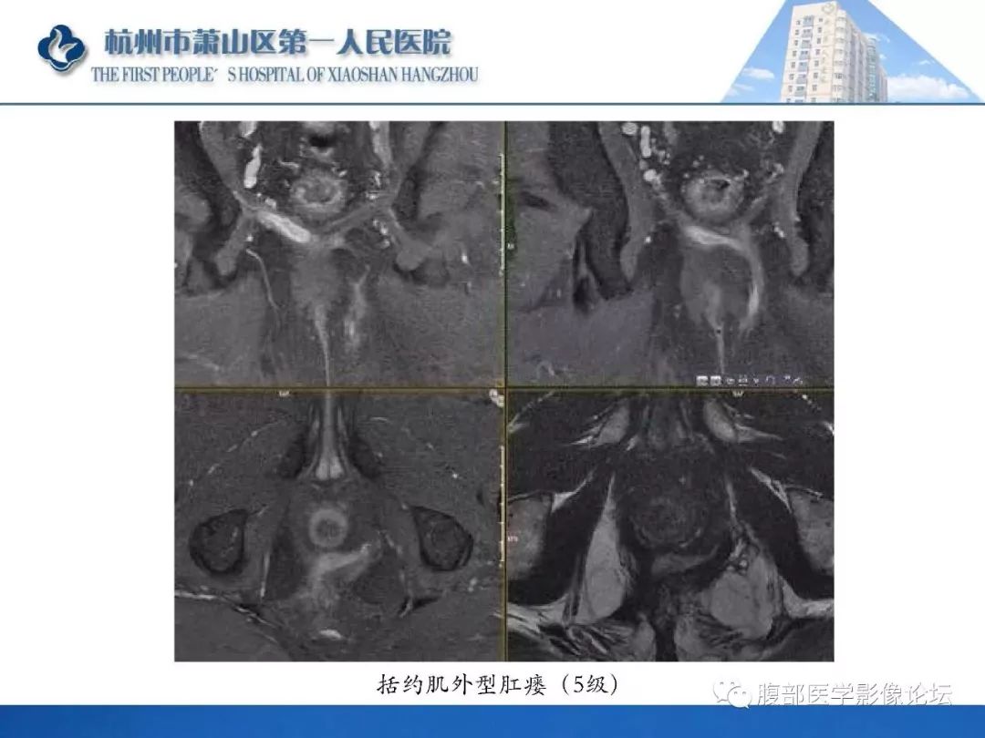 影像PPT - 【PPT】肛瘘MRI诊断-34 影像PPT - 【PPT】肛瘘MRI诊断-34