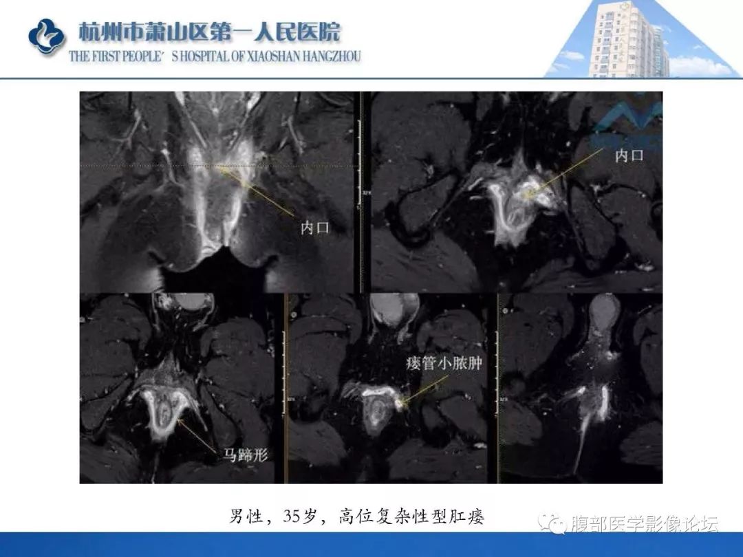 影像PPT - 【PPT】肛瘘MRI诊断-37 影像PPT - 【PPT】肛瘘MRI诊断-37