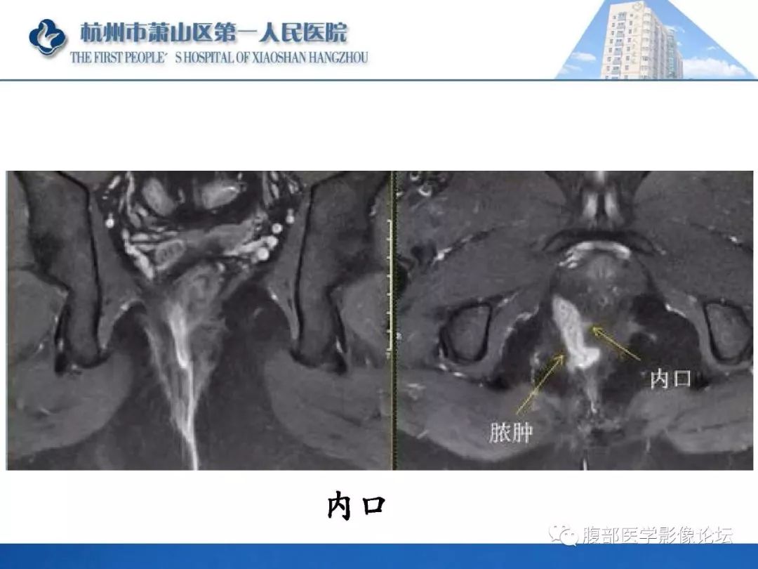 影像PPT - 【PPT】肛瘘MRI诊断-40 影像PPT - 【PPT】肛瘘MRI诊断-40