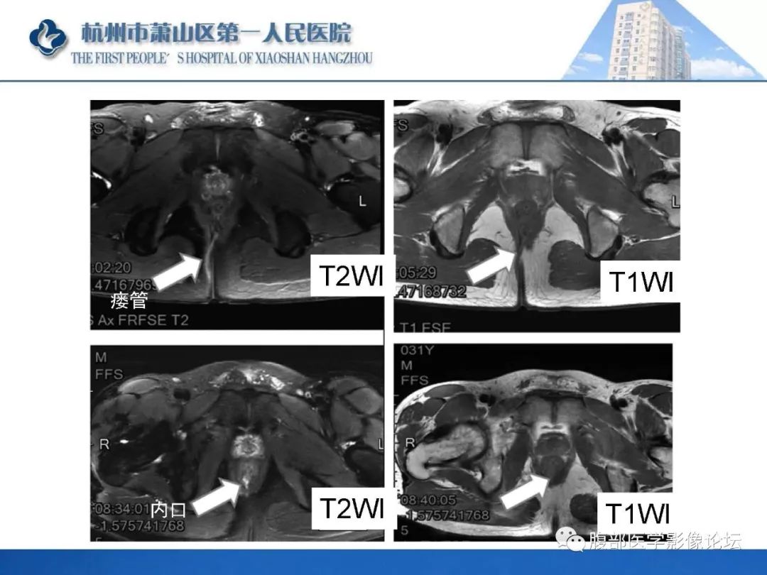 影像PPT - 【PPT】肛瘘MRI诊断-41 影像PPT - 【PPT】肛瘘MRI诊断-41