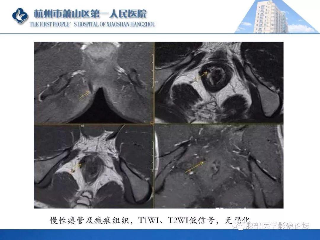 影像PPT - 【PPT】肛瘘MRI诊断-42 影像PPT - 【PPT】肛瘘MRI诊断-42
