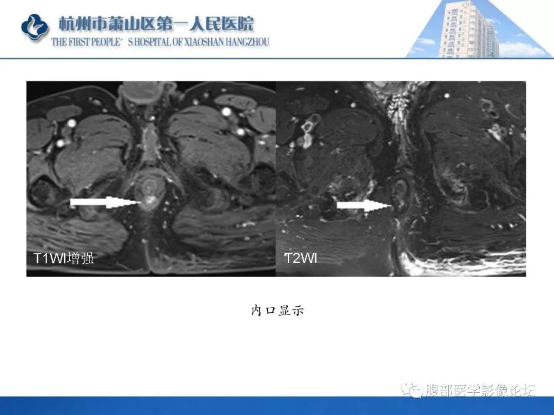 影像PPT - 【PPT】肛瘘MRI诊断-43 影像PPT - 【PPT】肛瘘MRI诊断-43