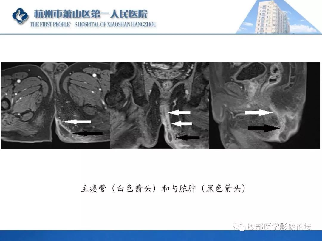 影像PPT - 【PPT】肛瘘MRI诊断-44 影像PPT - 【PPT】肛瘘MRI诊断-44