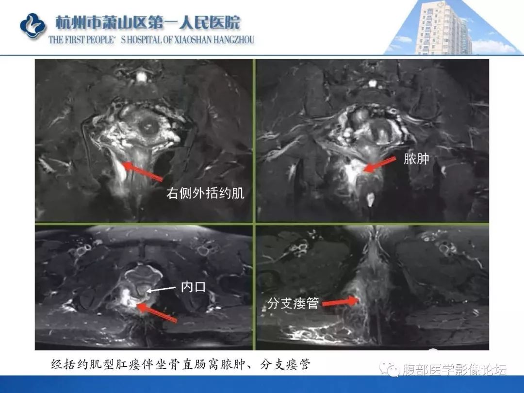影像PPT - 【PPT】肛瘘MRI诊断-45 影像PPT - 【PPT】肛瘘MRI诊断-45