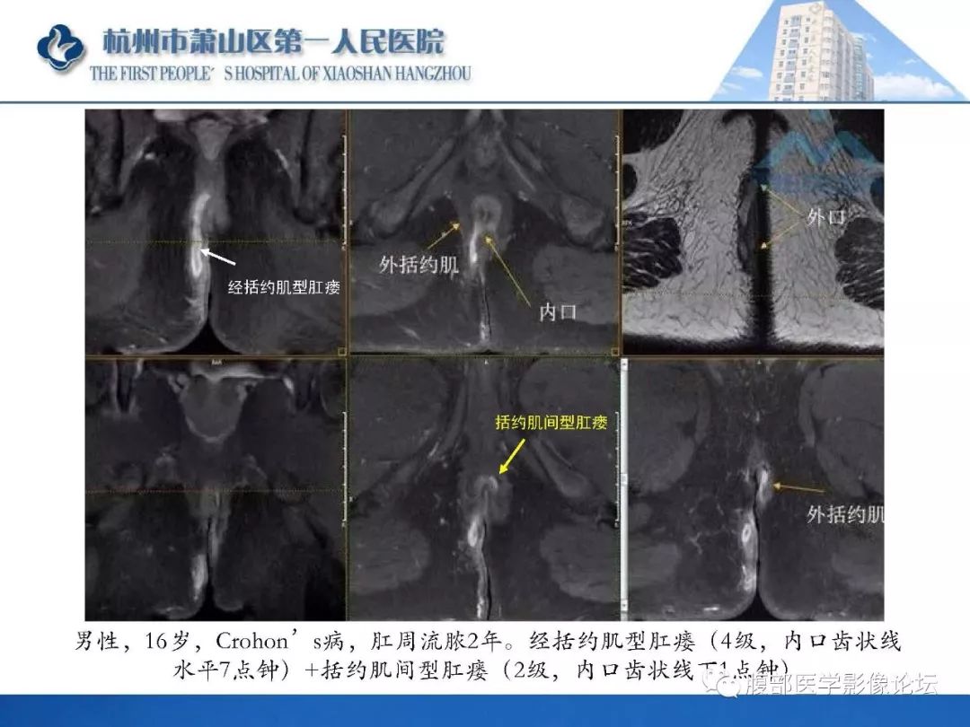 影像PPT - 【PPT】肛瘘MRI诊断-46 影像PPT - 【PPT】肛瘘MRI诊断-46