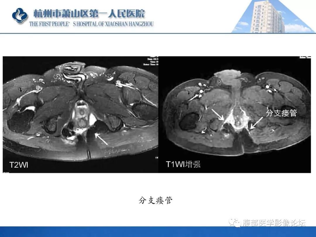 影像PPT - 【PPT】肛瘘MRI诊断-47 影像PPT - 【PPT】肛瘘MRI诊断-47