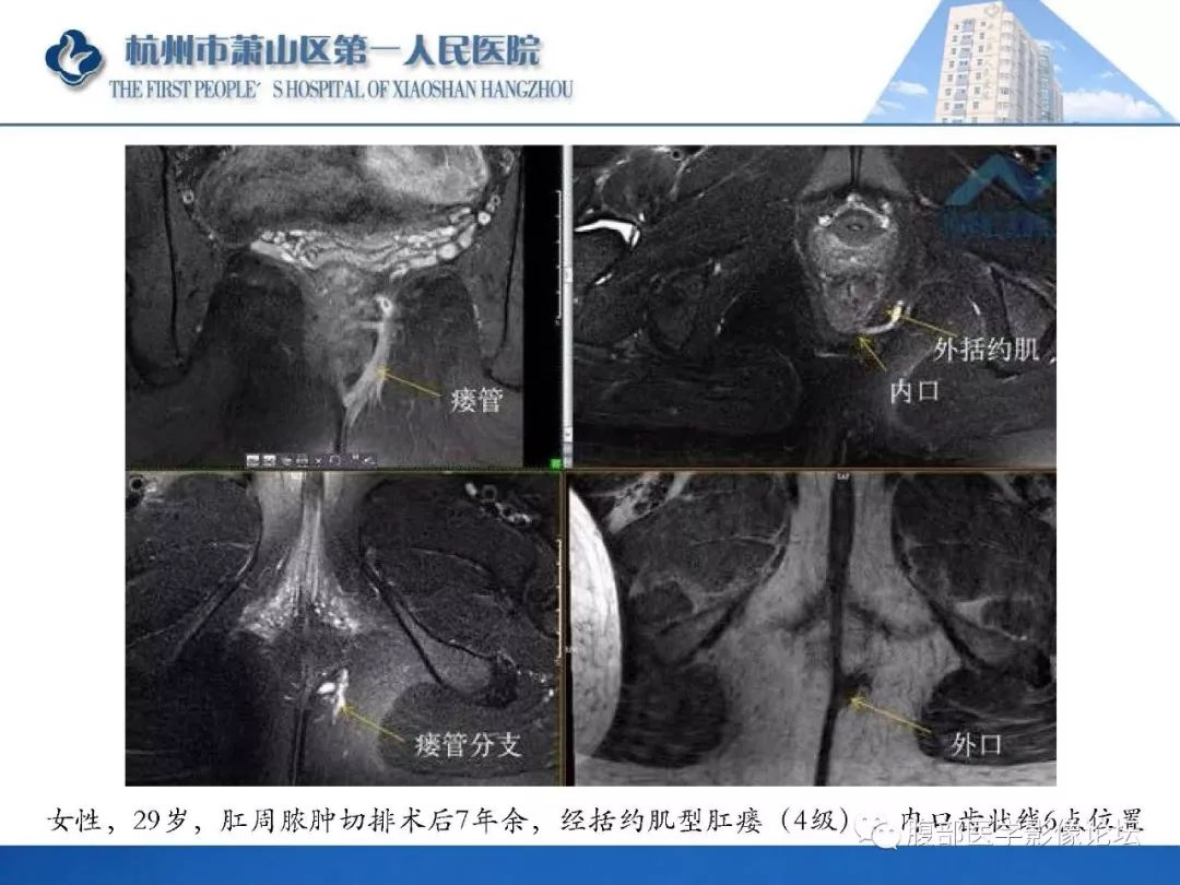 影像PPT - 【PPT】肛瘘MRI诊断-48 影像PPT - 【PPT】肛瘘MRI诊断-48