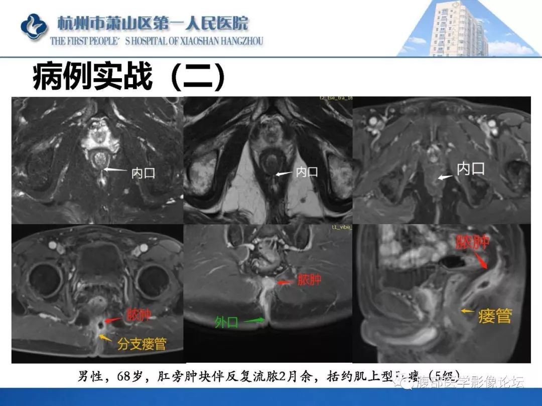 影像PPT - 【PPT】肛瘘MRI诊断-50 影像PPT - 【PPT】肛瘘MRI诊断-50