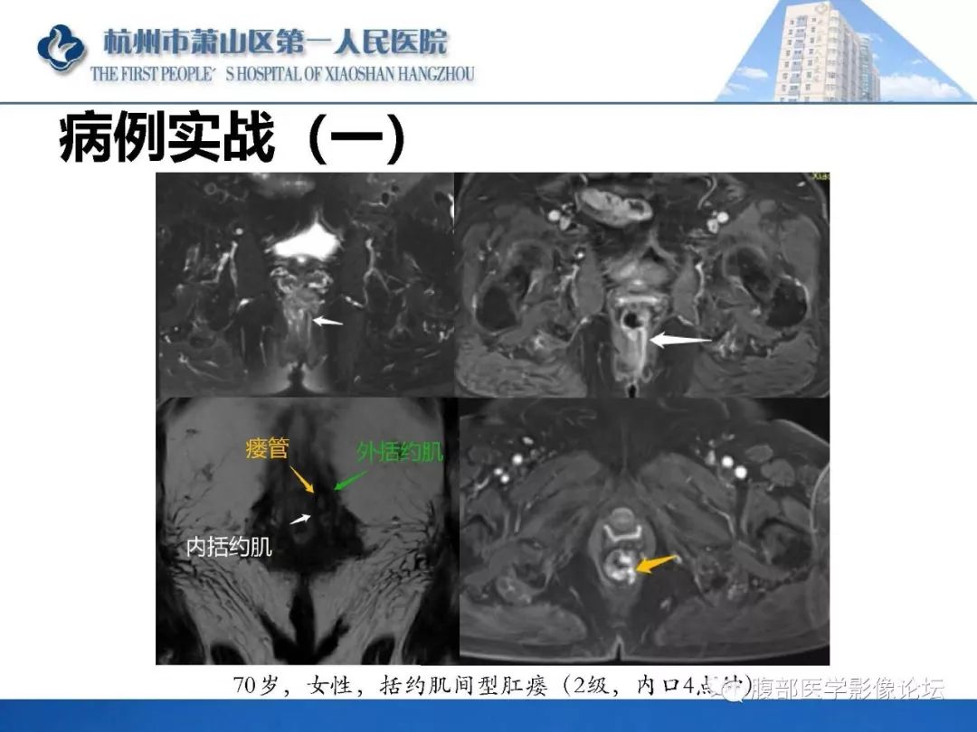 影像PPT - 【PPT】肛瘘MRI诊断-49 影像PPT - 【PPT】肛瘘MRI诊断-49