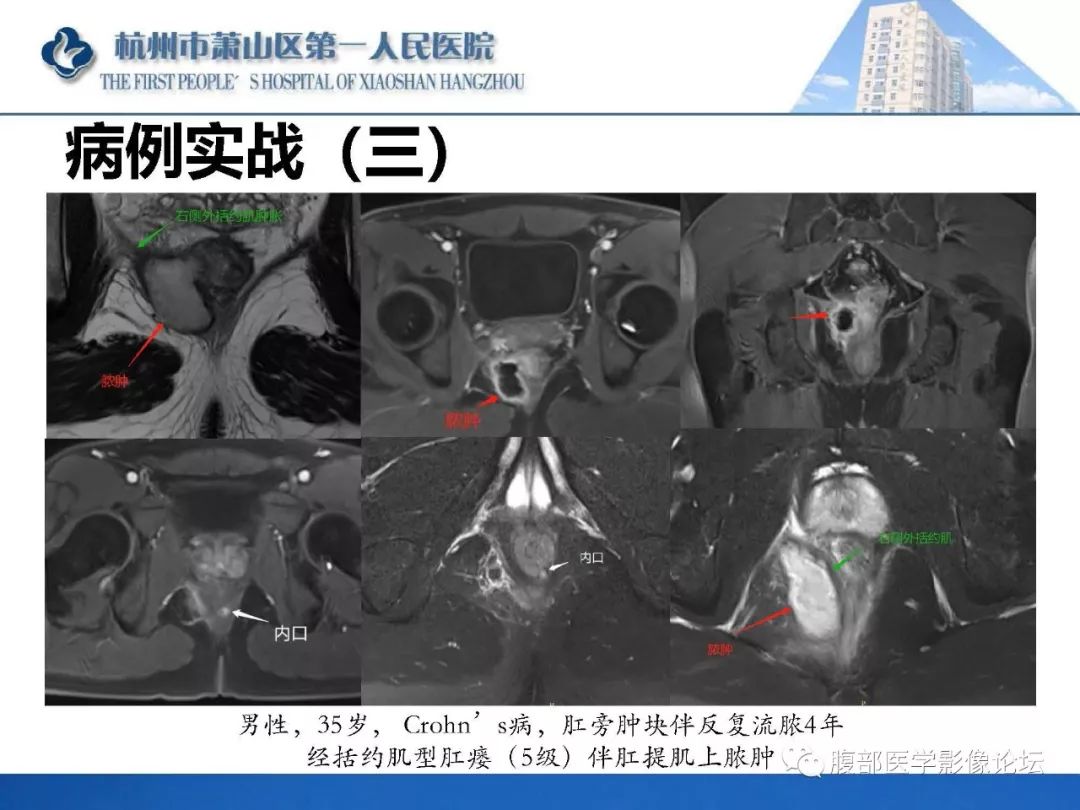 影像PPT - 【PPT】肛瘘MRI诊断-51 影像PPT - 【PPT】肛瘘MRI诊断-51