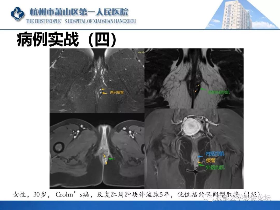 影像PPT - 【PPT】肛瘘MRI诊断-52 影像PPT - 【PPT】肛瘘MRI诊断-52