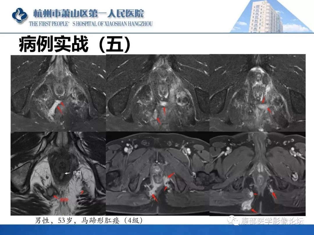 影像PPT - 【PPT】肛瘘MRI诊断-53 影像PPT - 【PPT】肛瘘MRI诊断-53