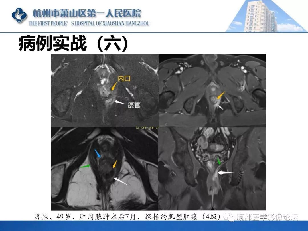 影像PPT - 【PPT】肛瘘MRI诊断-54 影像PPT - 【PPT】肛瘘MRI诊断-54