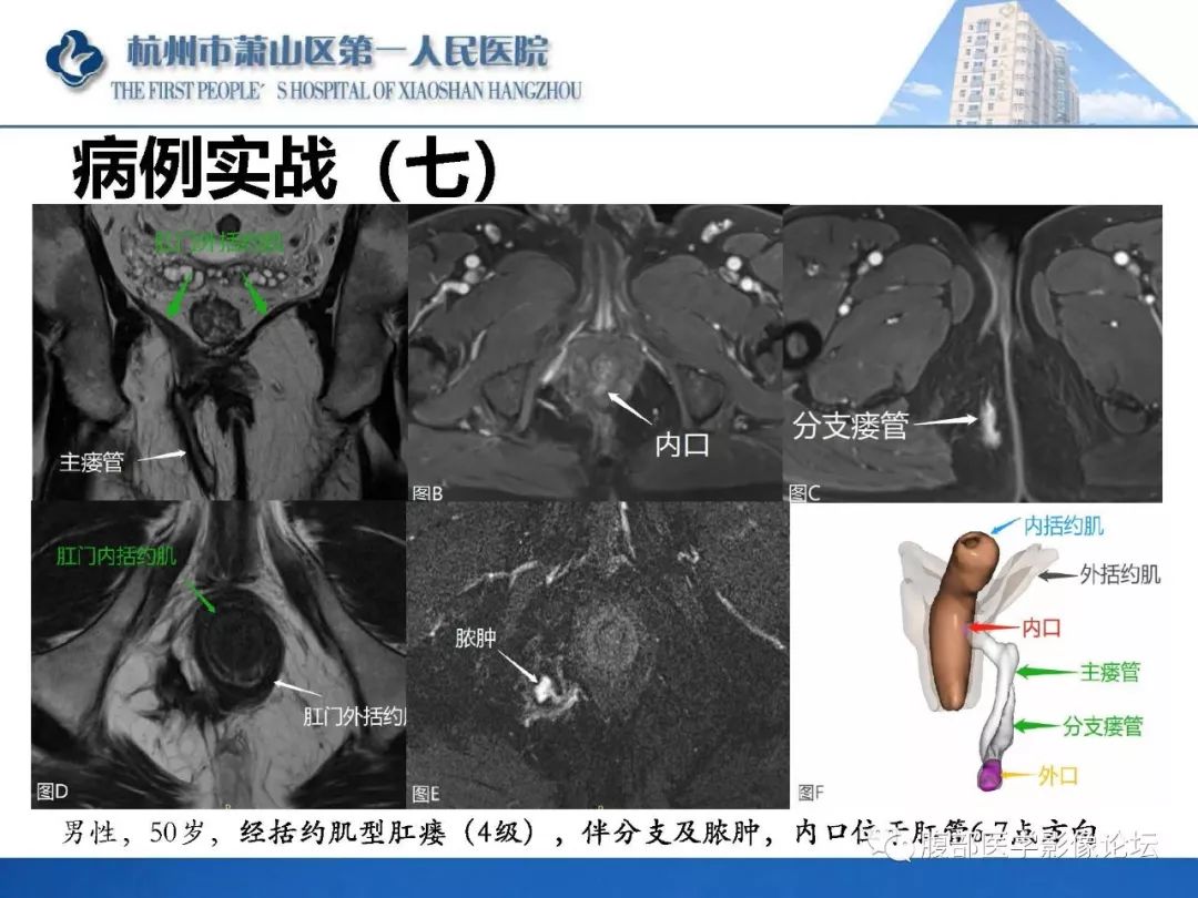 影像PPT - 【PPT】肛瘘MRI诊断-55 影像PPT - 【PPT】肛瘘MRI诊断-55