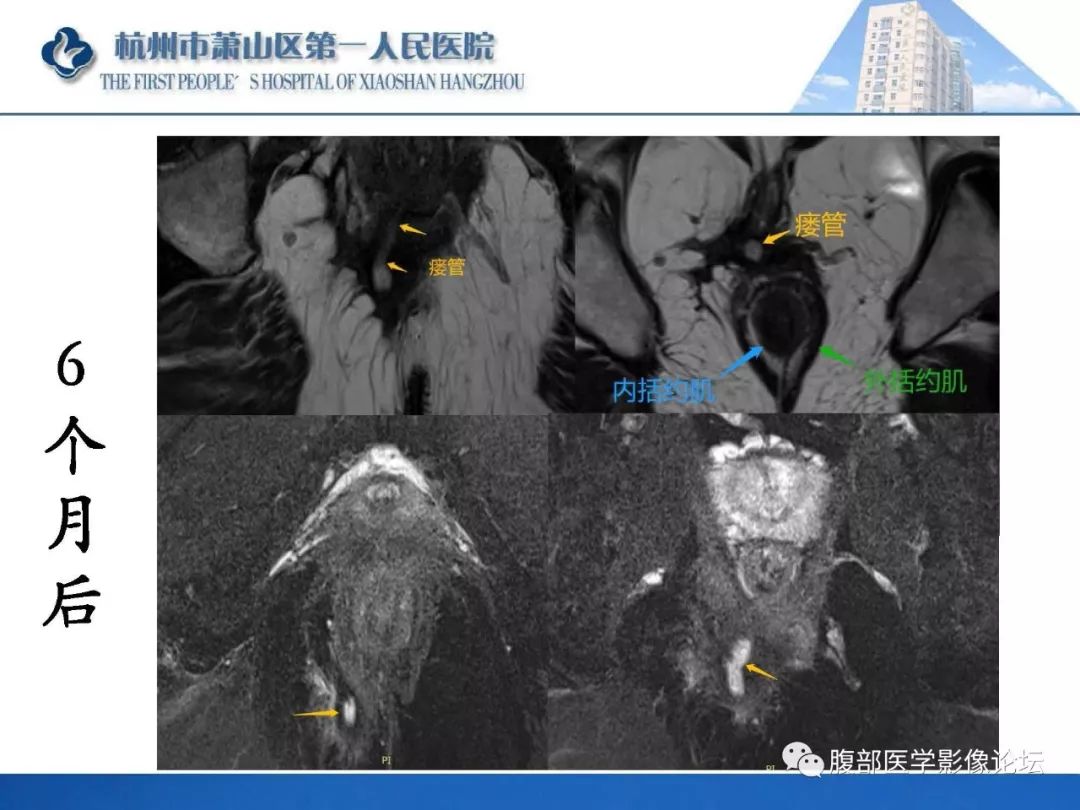 影像PPT - 【PPT】肛瘘MRI诊断-56 影像PPT - 【PPT】肛瘘MRI诊断-56