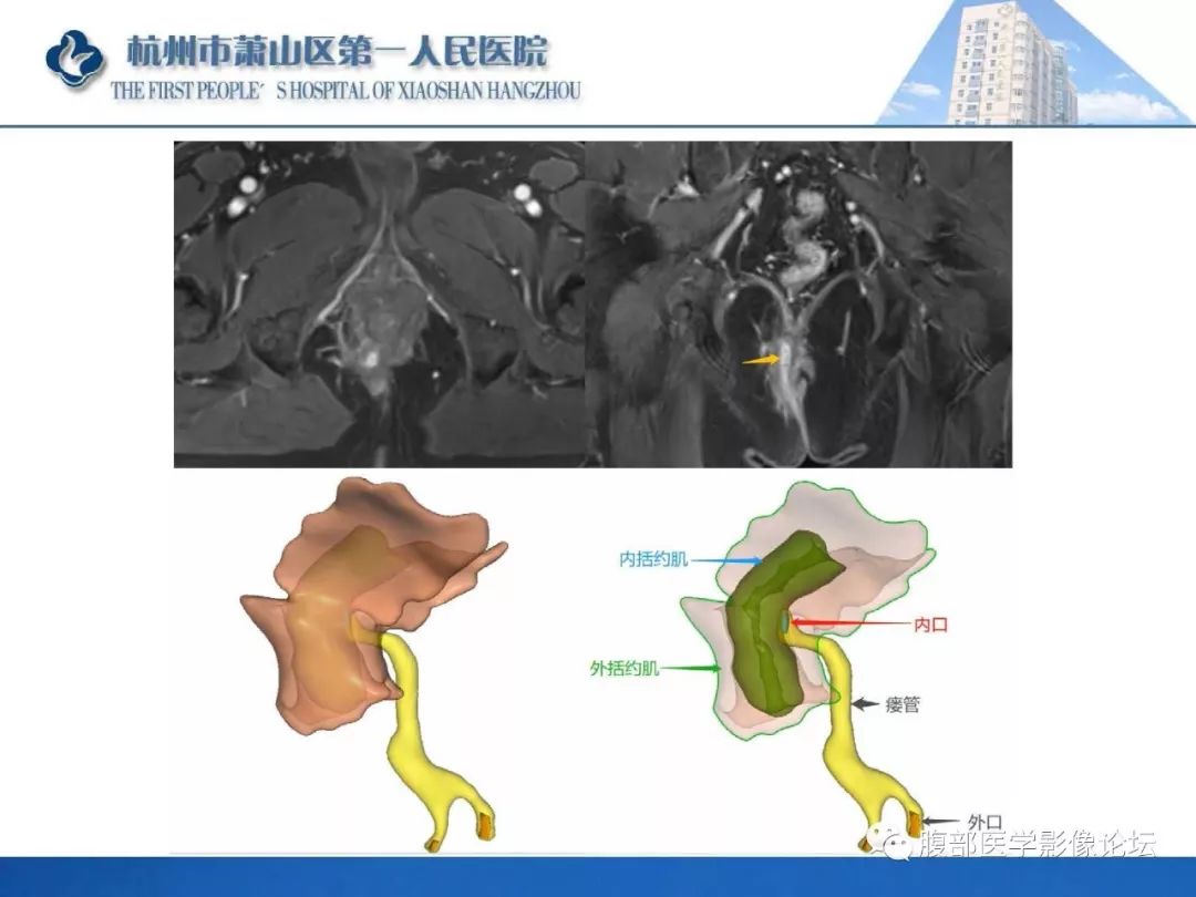 影像PPT - 【PPT】肛瘘MRI诊断-57 影像PPT - 【PPT】肛瘘MRI诊断-57