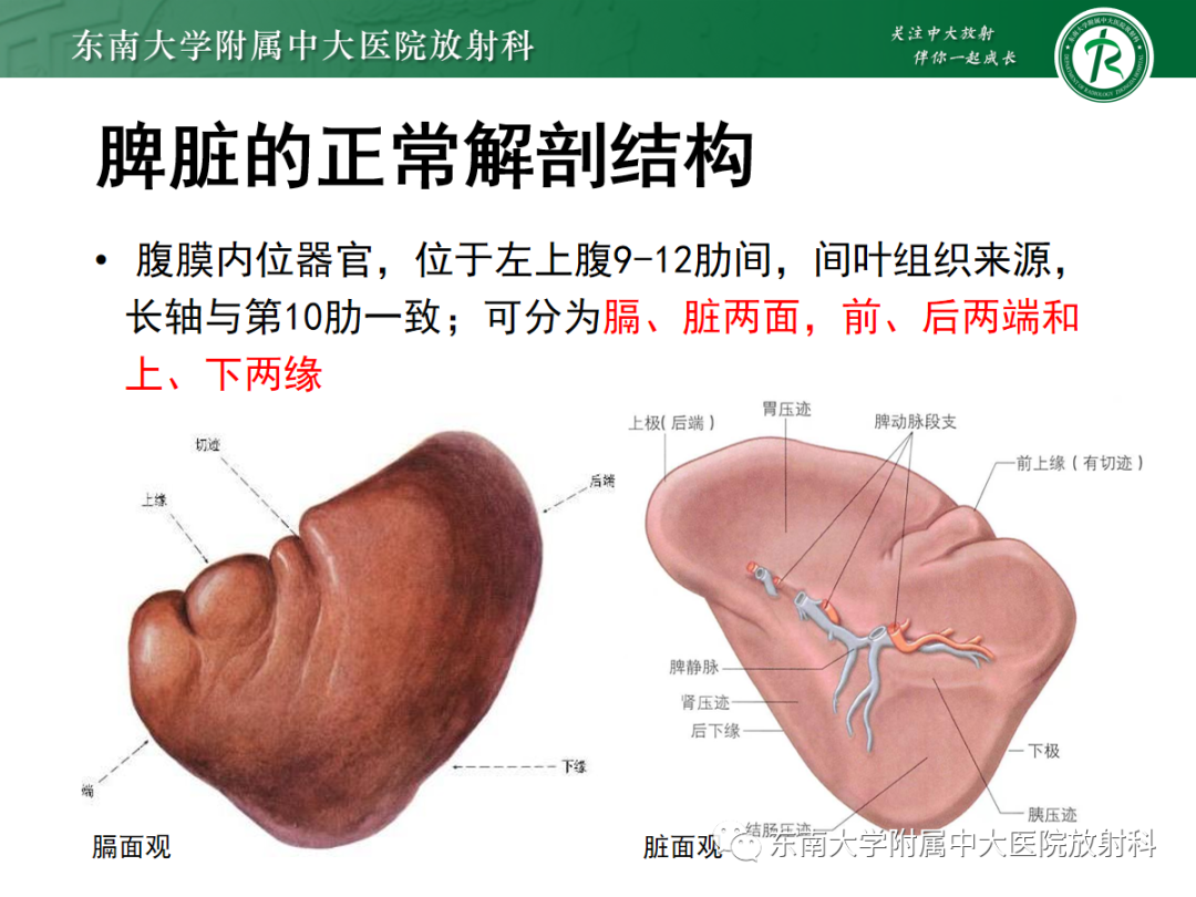 影像PPT - 【PPT】脾脏先天性变异-3