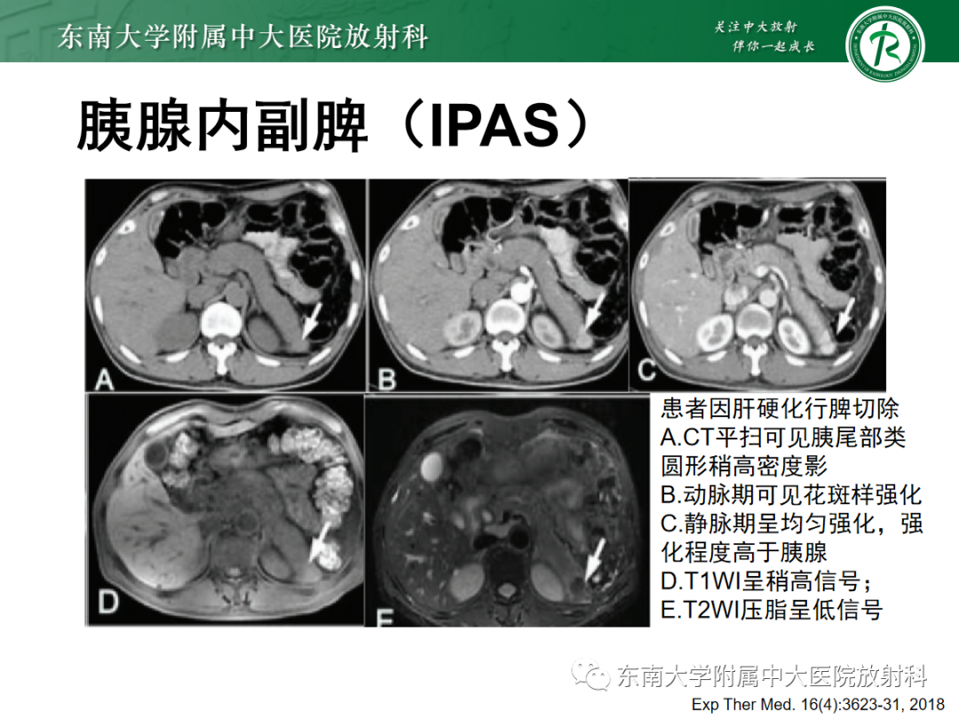 影像PPT - 【PPT】脾脏先天性变异-10