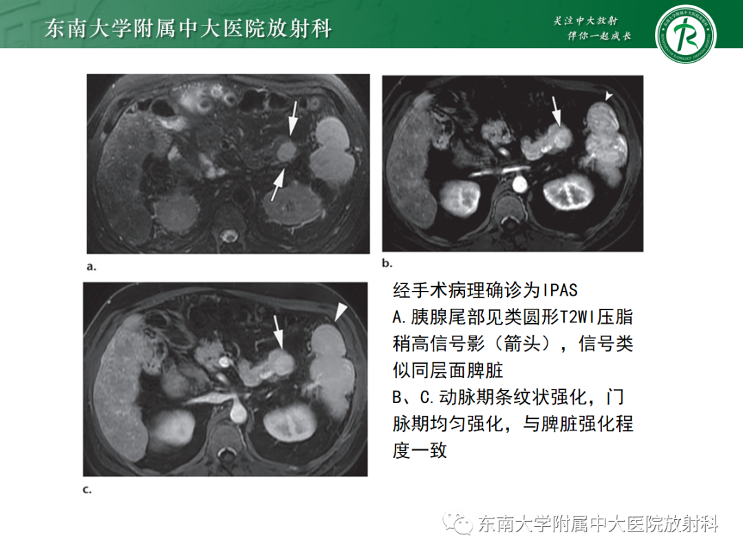 影像PPT - 【PPT】脾脏先天性变异-11