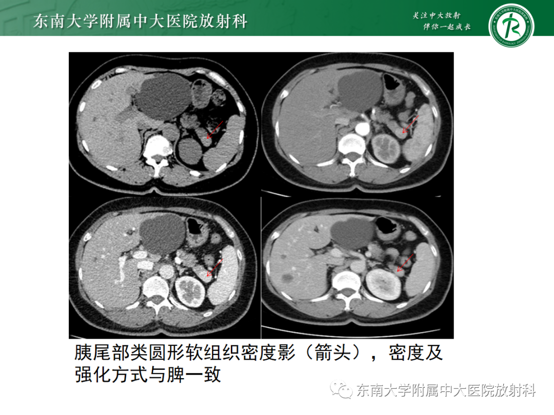 影像PPT - 【PPT】脾脏先天性变异-9