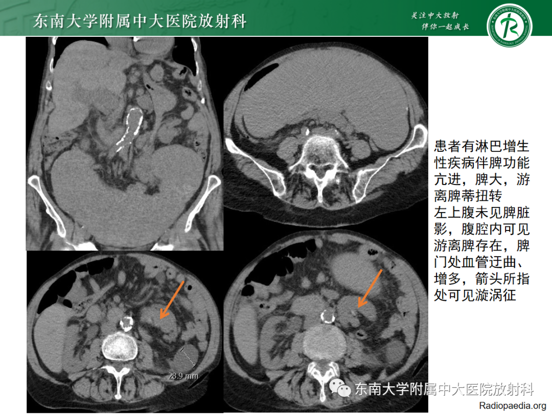 影像PPT - 【PPT】脾脏先天性变异-18