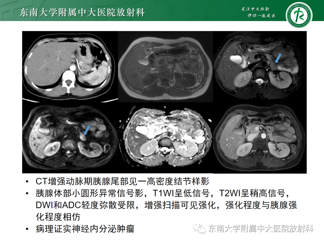 影像PPT - 【PPT】脾脏先天性变异-13