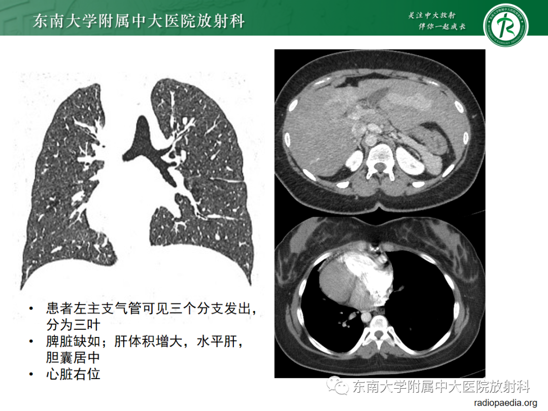 影像PPT - 【PPT】脾脏先天性变异-25