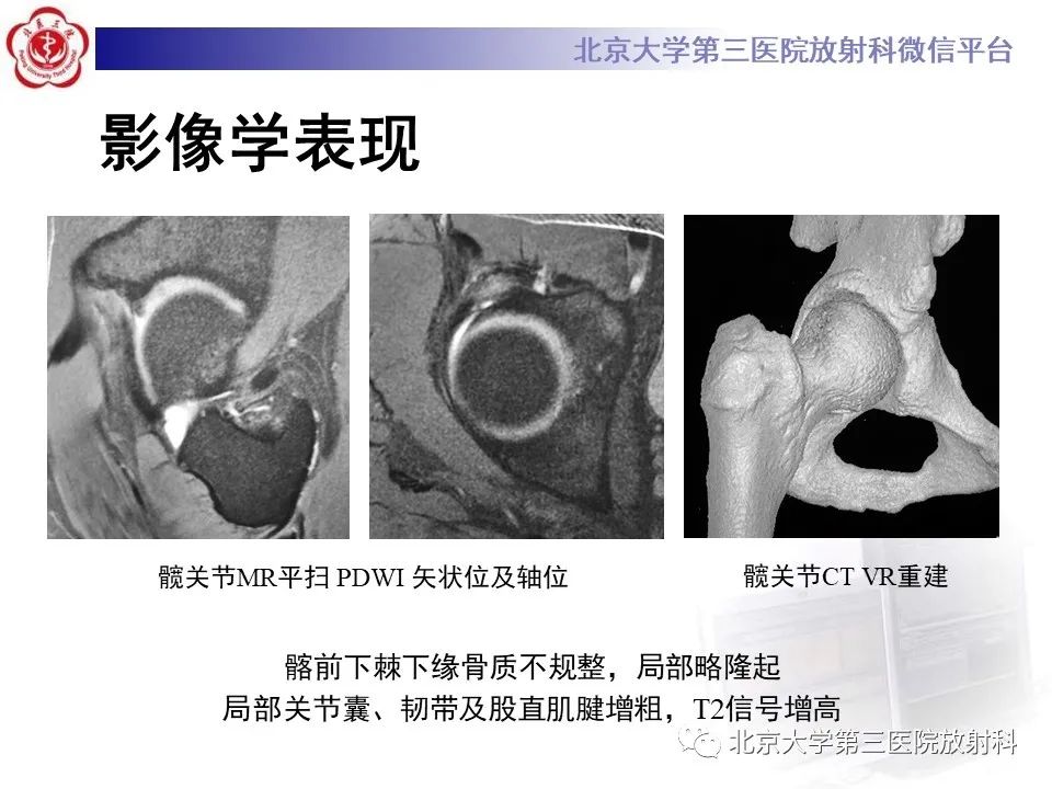 影像PPT - 【PPT】髋关节髂前下棘撞击-3