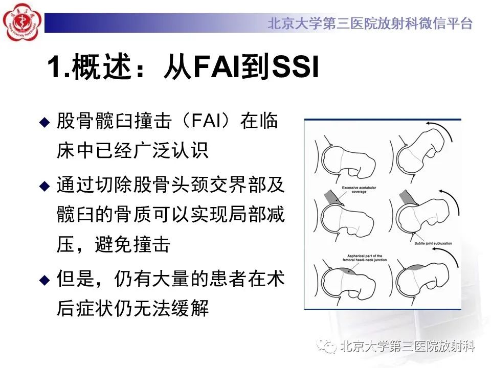 影像PPT - 【PPT】髋关节髂前下棘撞击-5