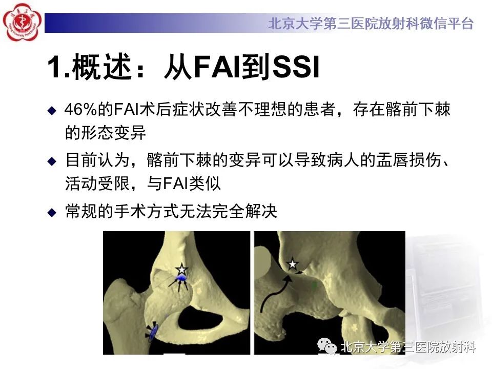 影像PPT - 【PPT】髋关节髂前下棘撞击-6