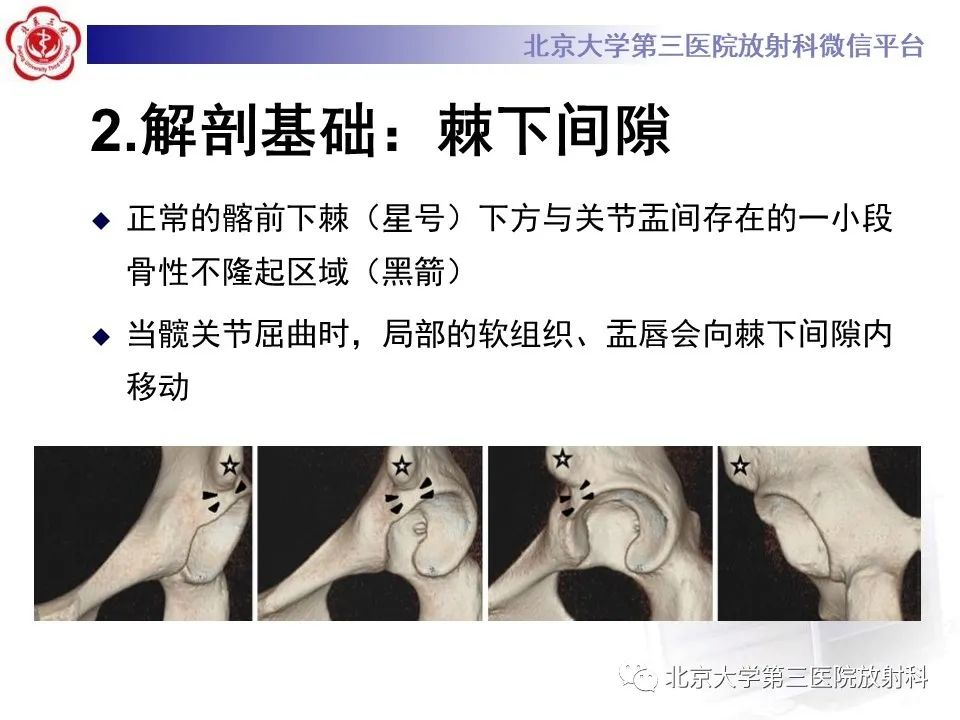 影像PPT - 【PPT】髋关节髂前下棘撞击-10