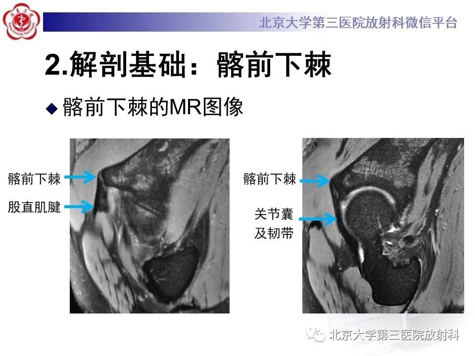 影像PPT - 【PPT】髋关节髂前下棘撞击-9