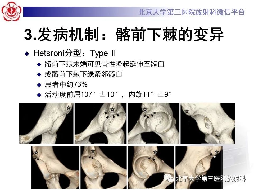 影像PPT - 【PPT】髋关节髂前下棘撞击-13