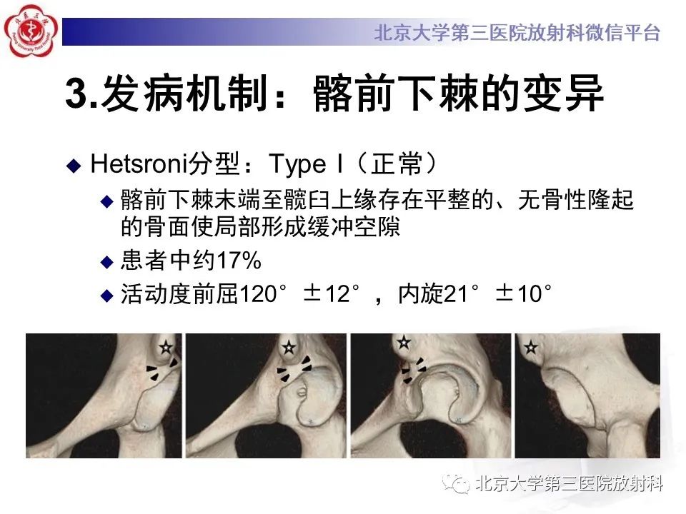 影像PPT - 【PPT】髋关节髂前下棘撞击-12