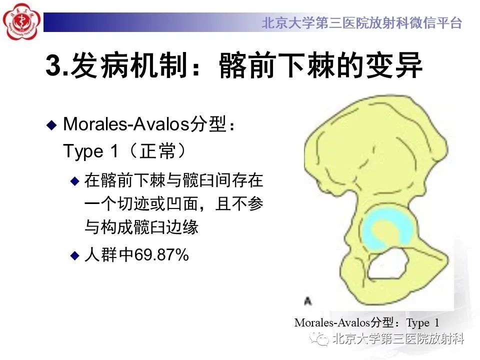 影像PPT - 【PPT】髋关节髂前下棘撞击-15
