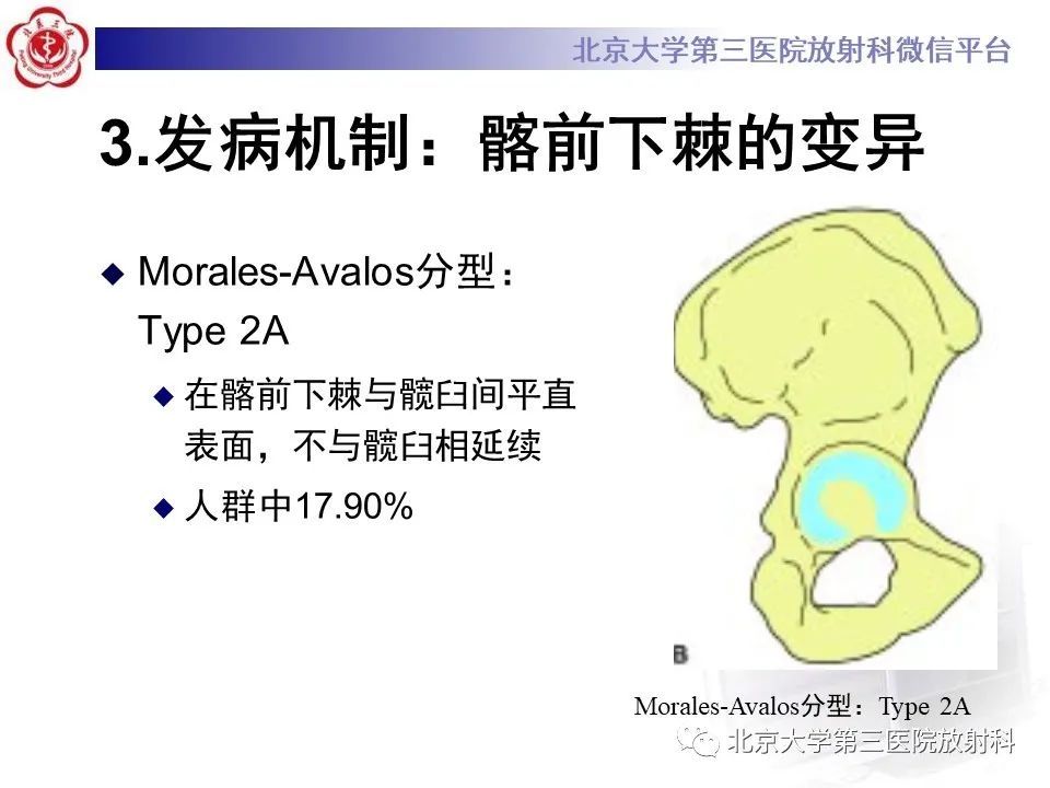 影像PPT - 【PPT】髋关节髂前下棘撞击-16