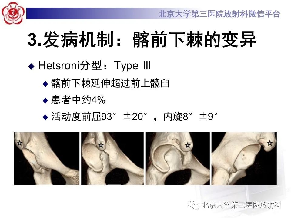 影像PPT - 【PPT】髋关节髂前下棘撞击-14