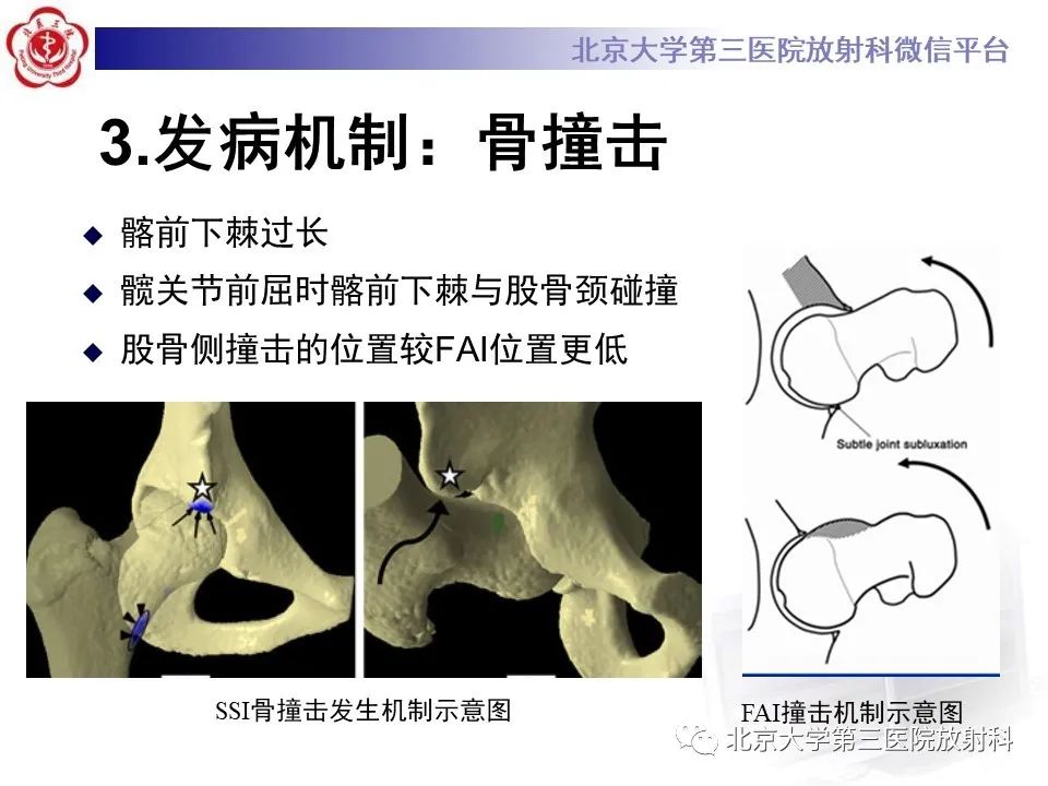 影像PPT - 【PPT】髋关节髂前下棘撞击-19