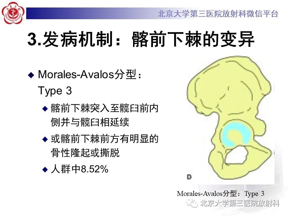 影像PPT - 【PPT】髋关节髂前下棘撞击-18