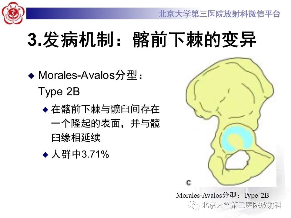 影像PPT - 【PPT】髋关节髂前下棘撞击-17